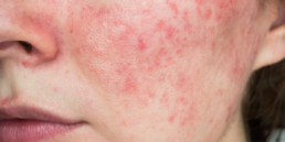 Voedingstriggers en rosacea