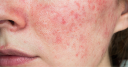 Voedingstriggers en rosacea